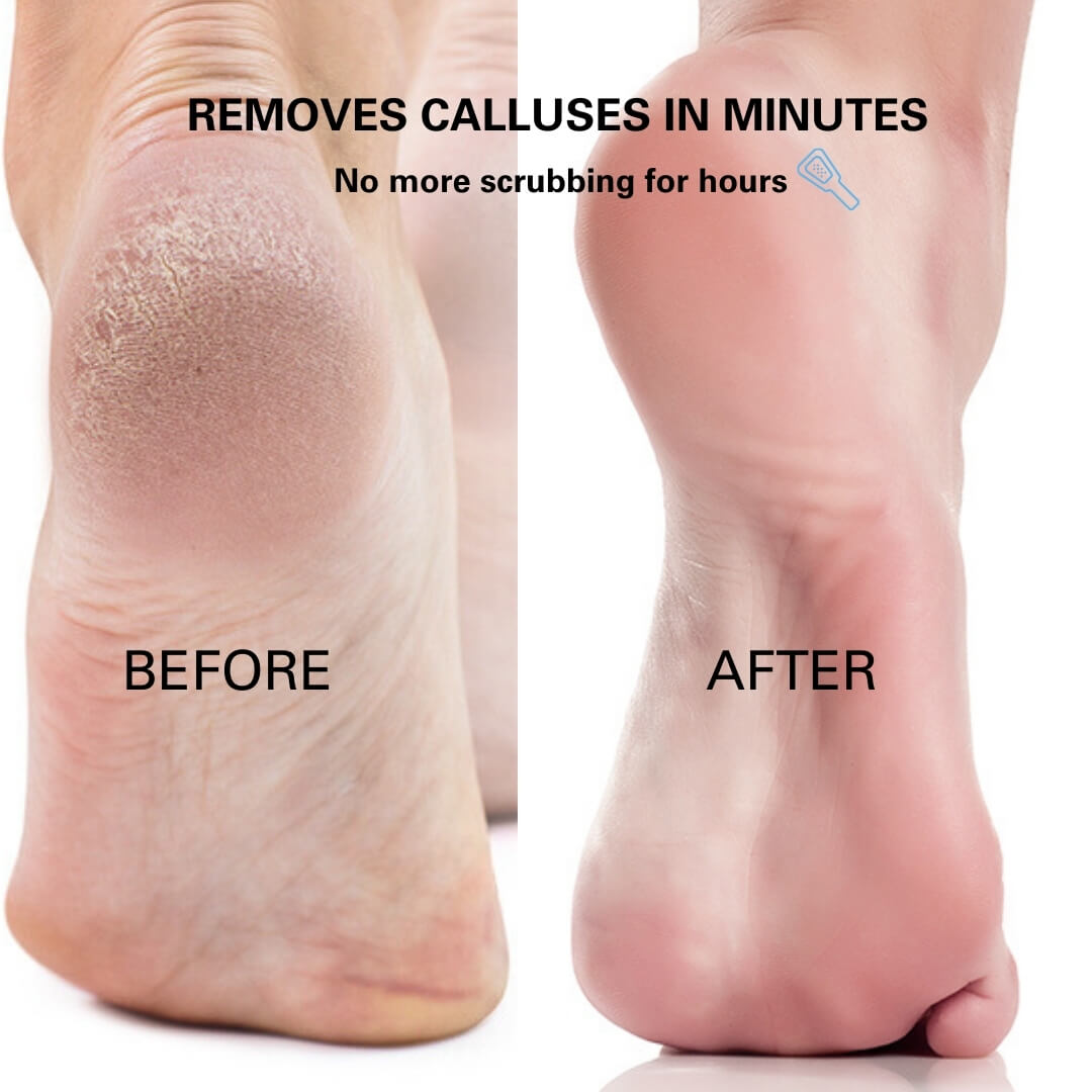 Blissal Rechargeable Foot Callus Remover