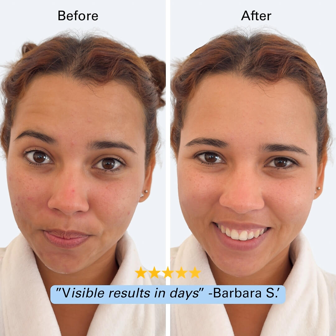 Before and after comparison of a woman's face with visible results using the Blissal face cleaner pro